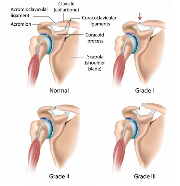 Grading-of-AC-Joint-Injury