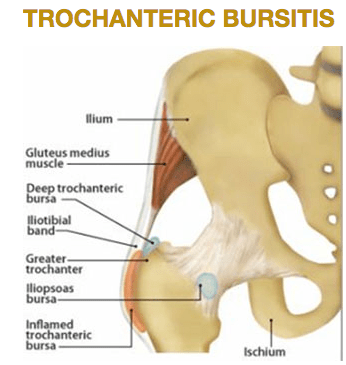 Trochanteric Bursitis
