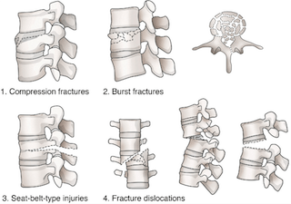 Classification of Vertebral Fractures