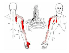 Thoracic Outlet Syndrome Pain Areas